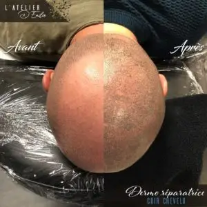 Tricopigmentation cuir chevelu pont-audemer 27500